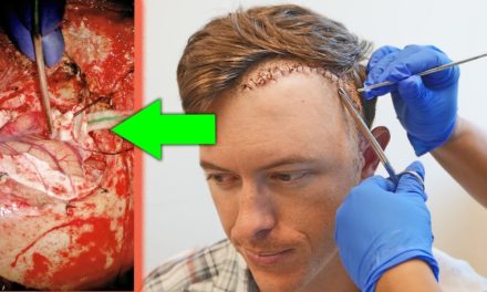 LakeForkGuy – LOOKING INSIDE MY BRAIN! | What a Large Brain Tumor Looks Like