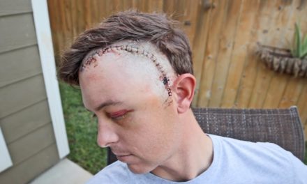 LakeForkGuy – Revealing My Face After Brain Surgery (Graphic)